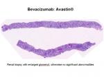 img-bevacizumab-0010.jpg