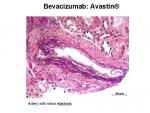 img-bevacizumab-0021.jpg